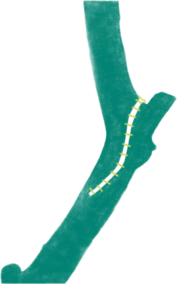 Sutured nature 3 project